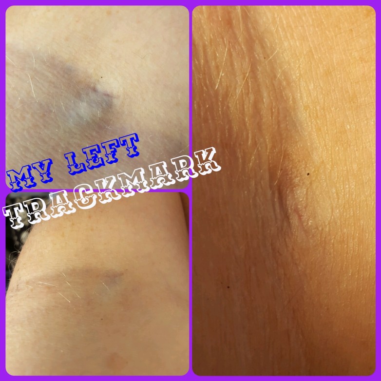 Collage of three close up images of my trackmark. Framed to be reminiscent of vaginas. 